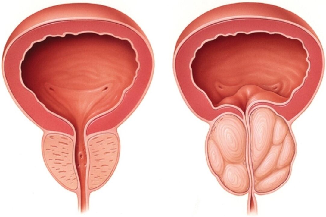 Normální prostata (vlevo) a se známkami zánětu při prostatitidě (vpravo)