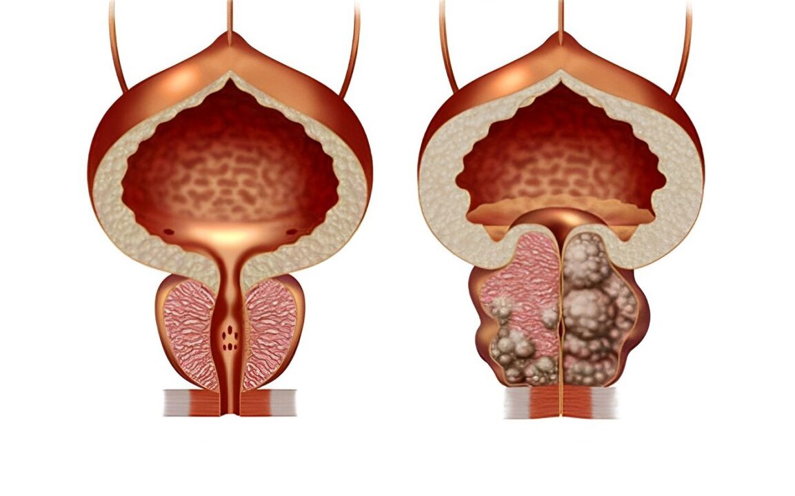 jak vypadá adenom prostaty 