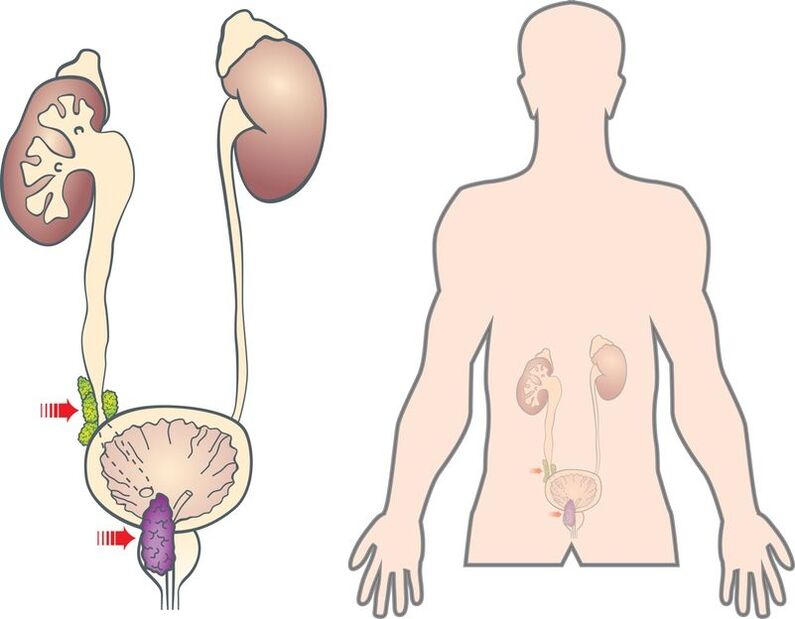 příznaky a příčiny adenomu prostaty