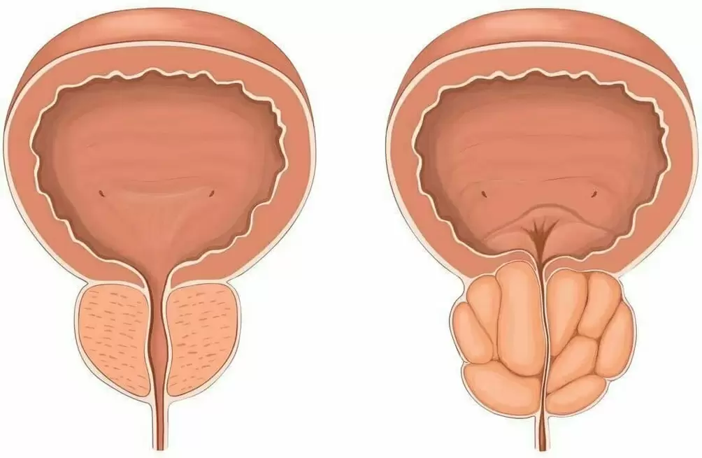 Normální prostata a bolest prostaty