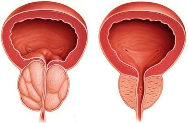 zdravá a zanícená prostata s prostatitidou